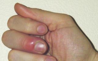 Нарывает палец что делать, как лечить нарывы на пальце?